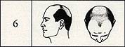 stage 6 male pattern baldness