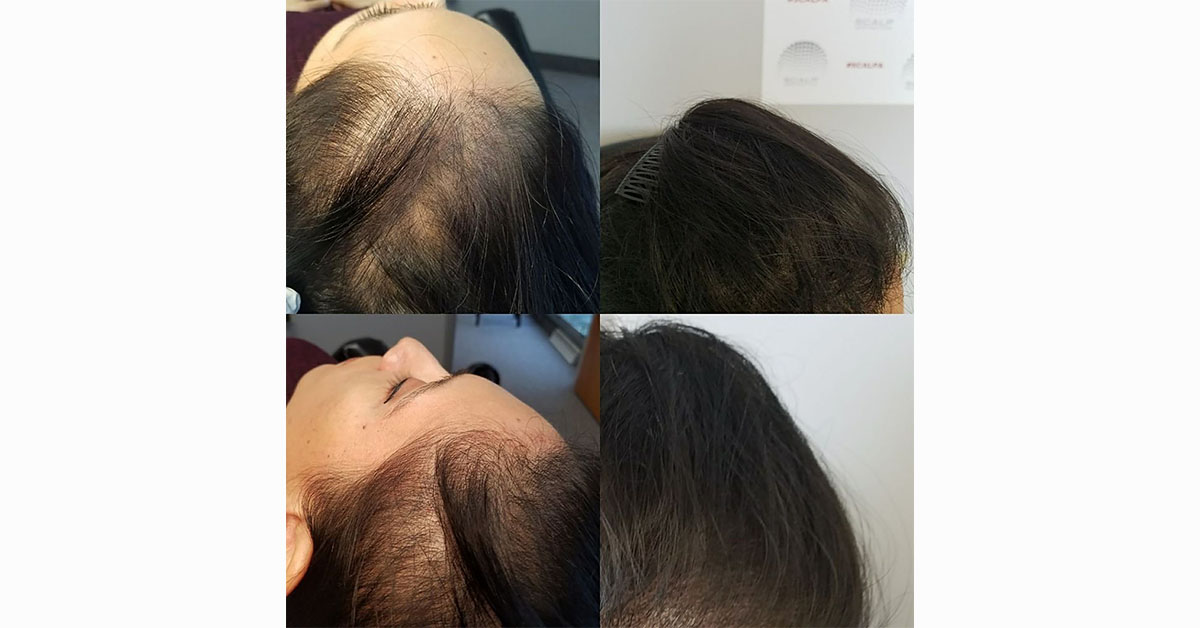 How to Stop Female Crown Hair Thinning?