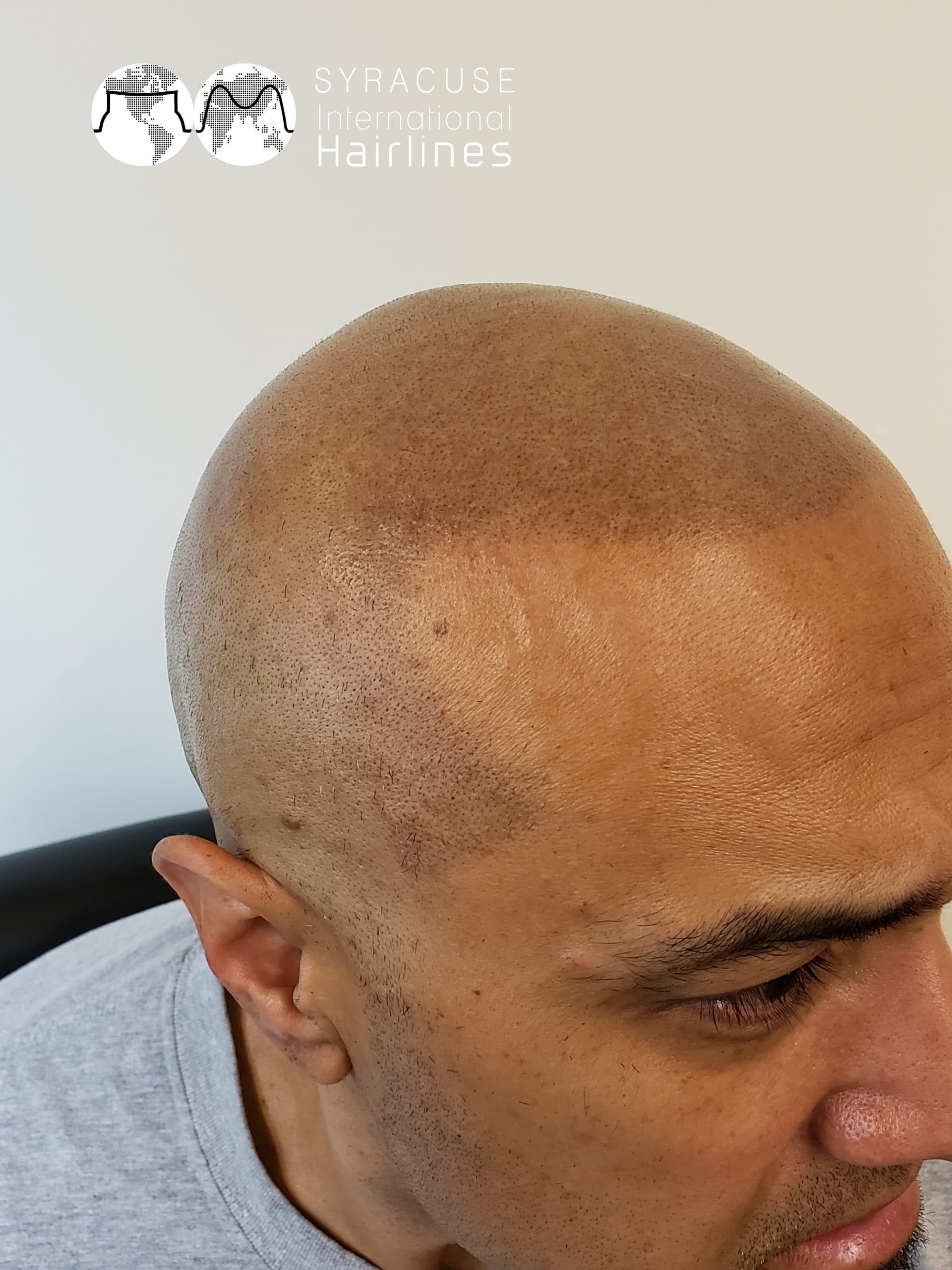 Hair Restoration Toronto: Scalp Micropigmentation vs Hair Transplant